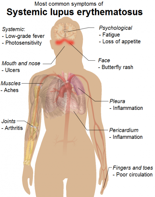 Symptoms_of_SLE